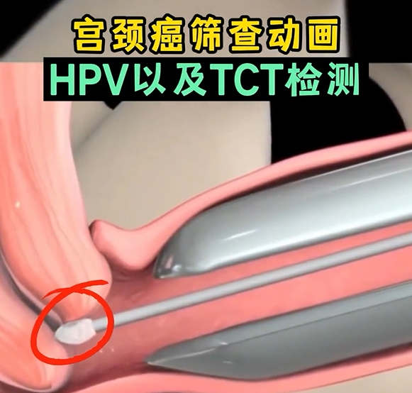 子宮頸檢查預約-家計會子宮頸檢查收費